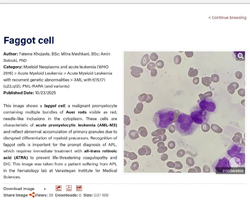 04 چاپ عکس در اطلس هماتولوژی انجمن هماتولوژی آمریکا (ASH